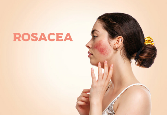 What to do against rosacea