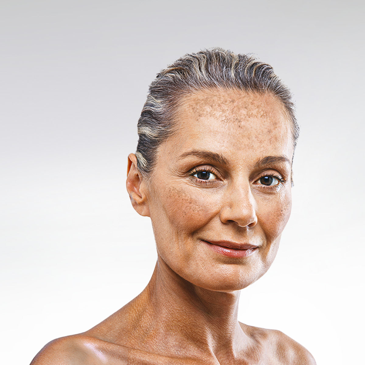 Pigment Spots